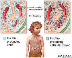 Type 1 Diabetes