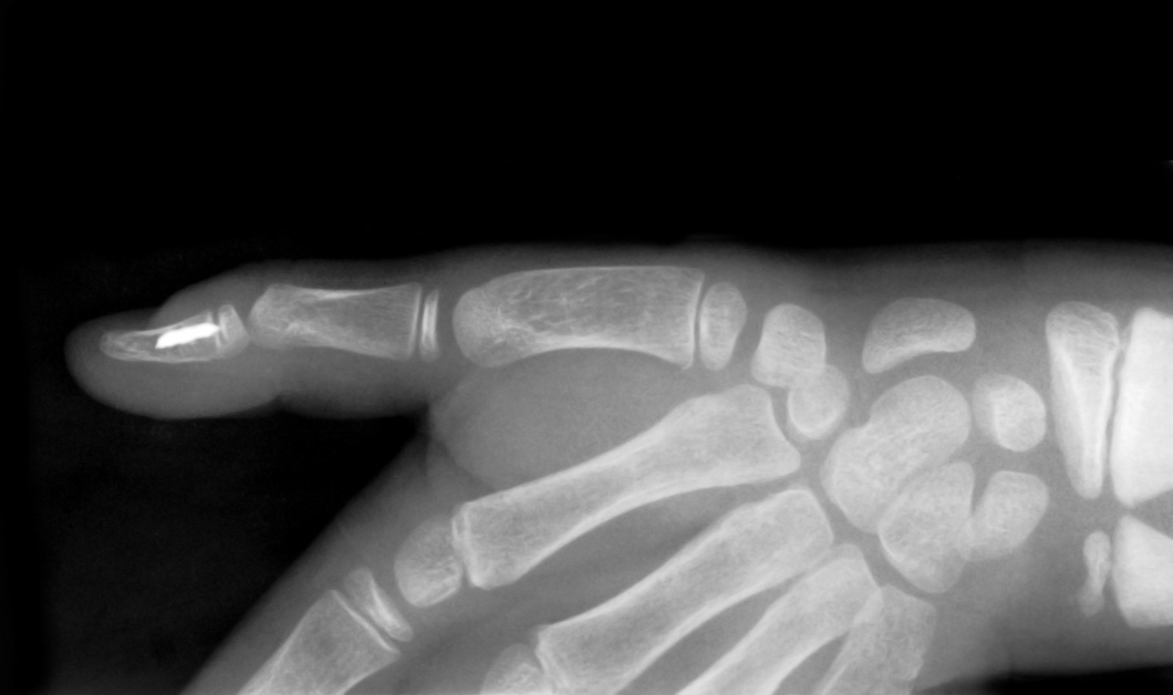 The Science Behind Broken Bones