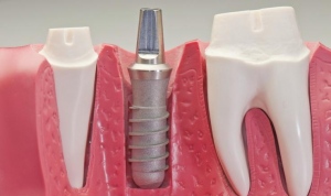 Dental Implants Las Vegas