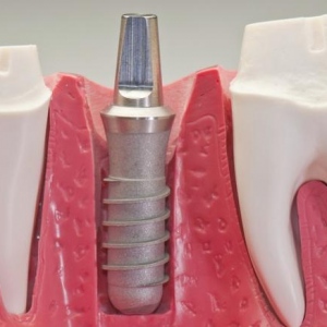 Dental Implants Las Vegas