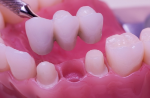 dental implants Scottsdale