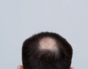 premature-hair