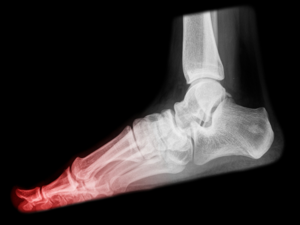 What Is A Stress Fracture And How Is It Caused?