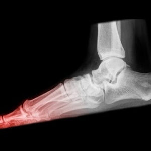 What Is A Stress Fracture And How Is It Caused?