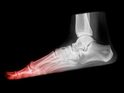 What Is A Stress Fracture And How Is It Caused?