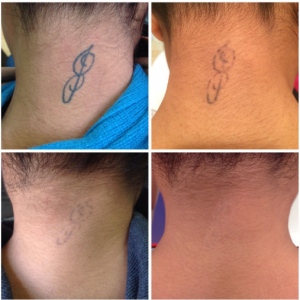 Check Out The Popular Tattoo Removal Options and Alternatives