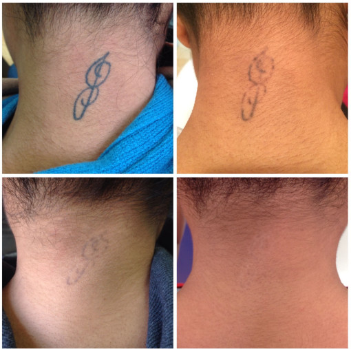 Check Out The Popular Tattoo Removal Options and Alternatives