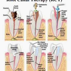 Root Canal Treatment