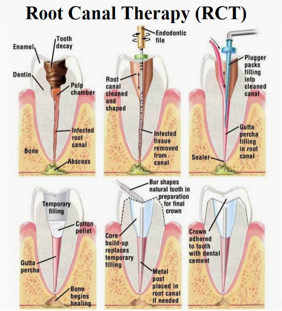 Root Canal Treatment