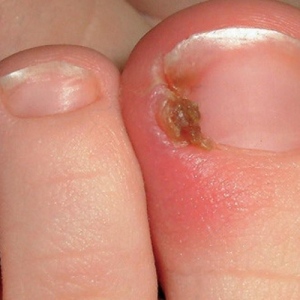 What Are The Symptoms Of Ingrown Toenails?