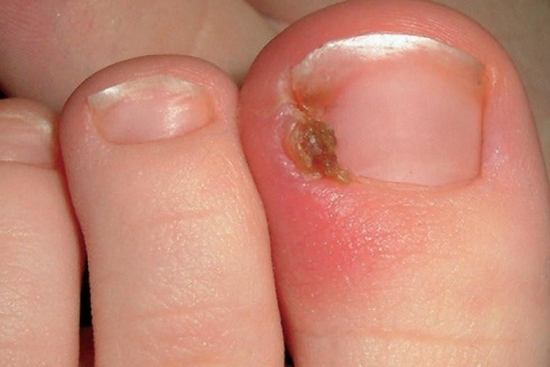 What Are The Symptoms Of Ingrown Toenails?