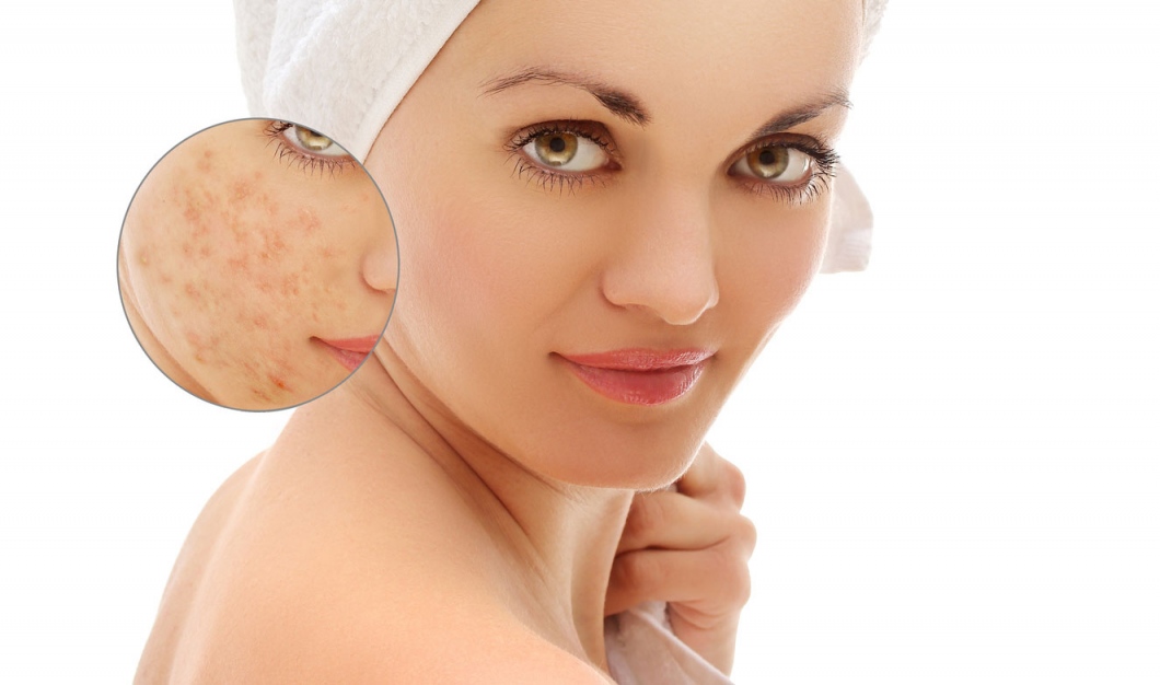 How To Get Rid Of Face Eczema? Some Helpful Tips You Can Use