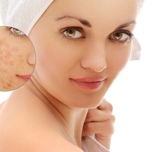 How To Get Rid Of Face Eczema? Some Helpful Tips You Can Use