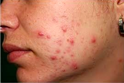 Home Remedies to Cure Acne 
