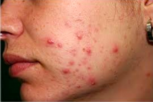 Home Remedies to Cure Acne